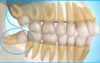 cirugias dentales