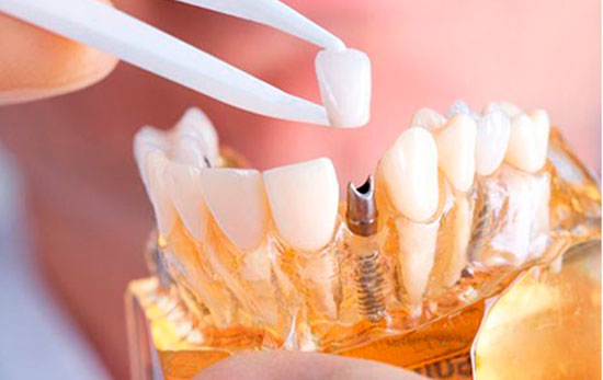 implantes dentales
